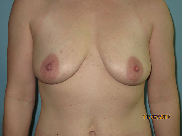 Breast Lift (Mastopexy)