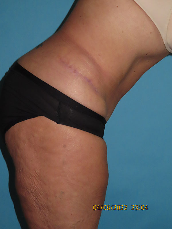 Tummy Tuck