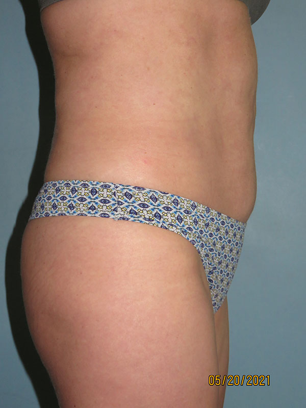 Tummy Tuck