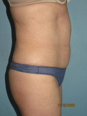 Tummy Tuck