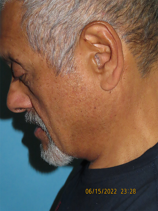 Neck Lift: Men