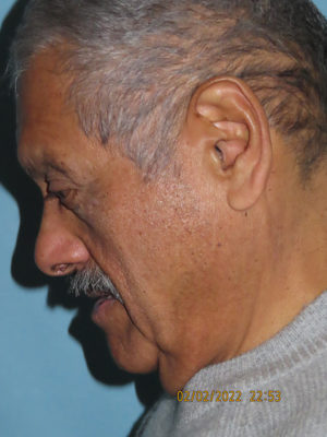 Neck Lift: Men
