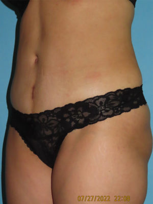 Tummy Tuck