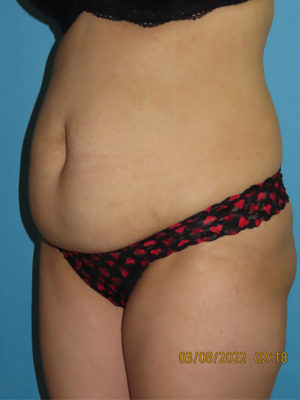 Tummy Tuck