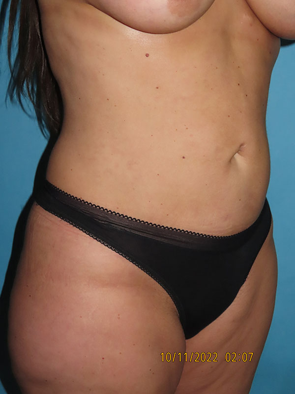 Liposuction