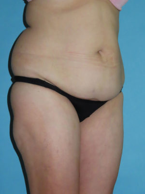 Liposuction