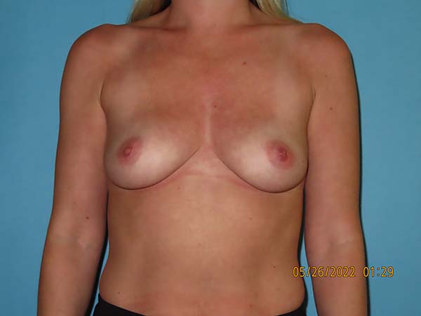 Breast Augmentation