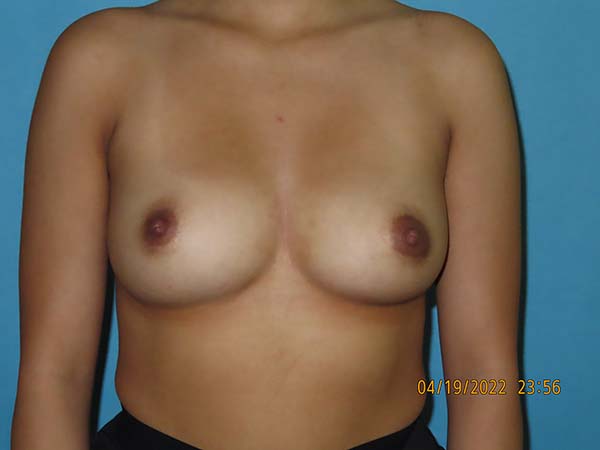 Breast Augmentation