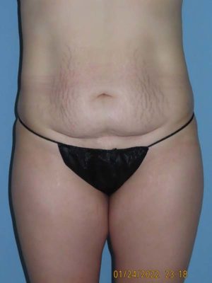 Tummy Tuck