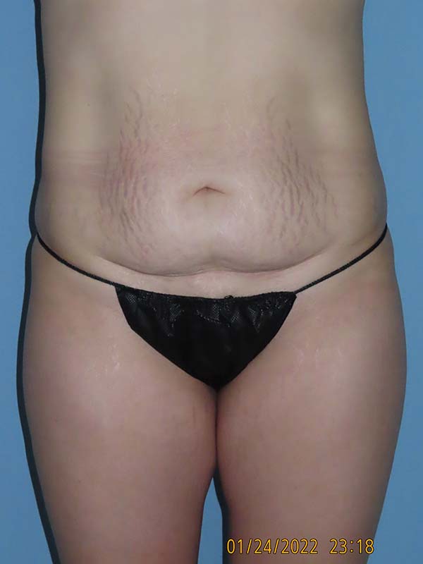 Tummy Tuck