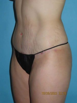 Tummy Tuck