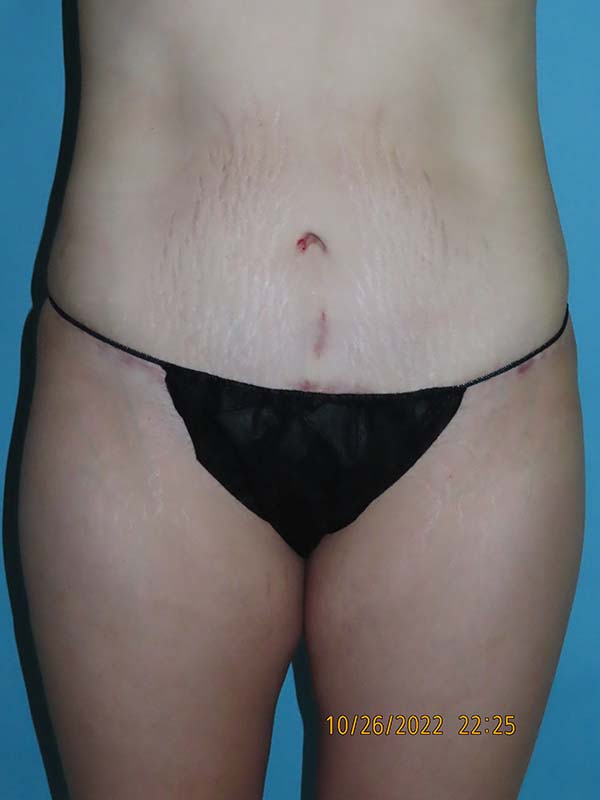 Tummy Tuck