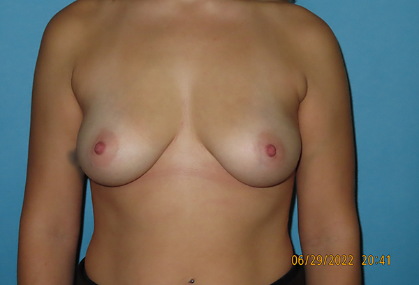 Breast Augmentation