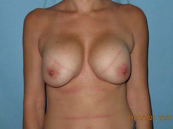 Breast Revision