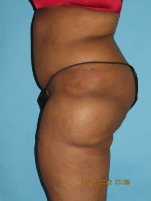 Tummy Tuck