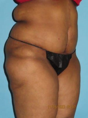 Tummy Tuck