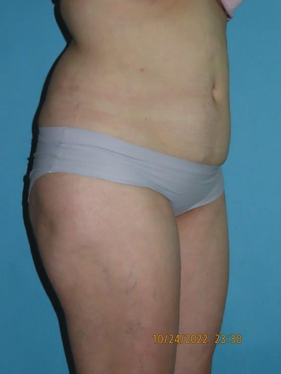 Liposuction