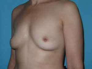 Breast Implant Removal