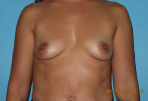 Breast Augmentation