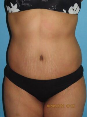 Tummy Tuck