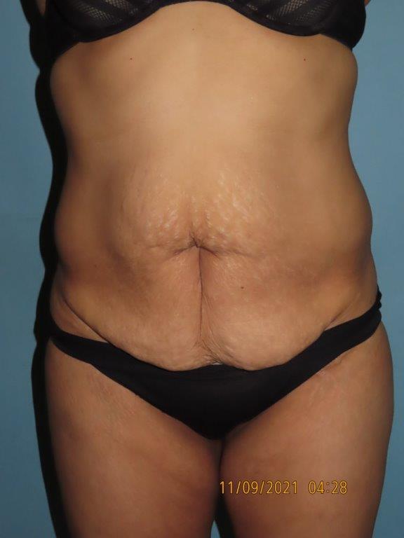 Tummy Tuck