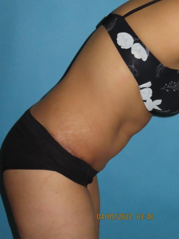 Tummy Tuck