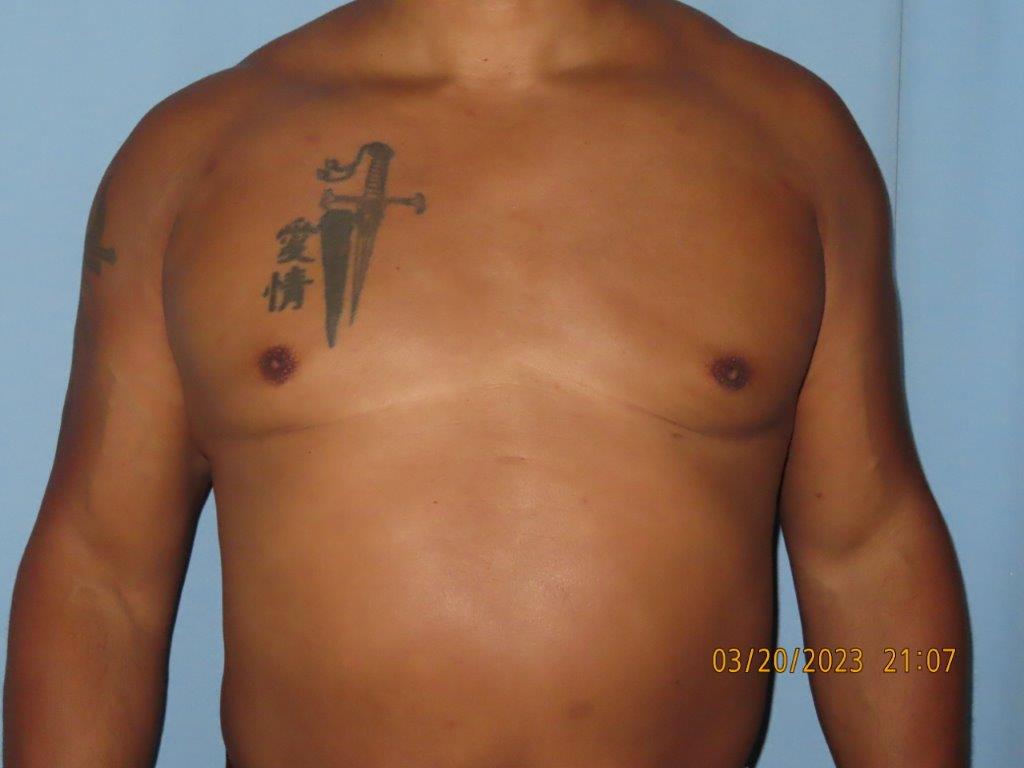 Male Breast Reduction - Gynecomastia