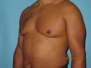 Male Breast Reduction - Gynecomastia