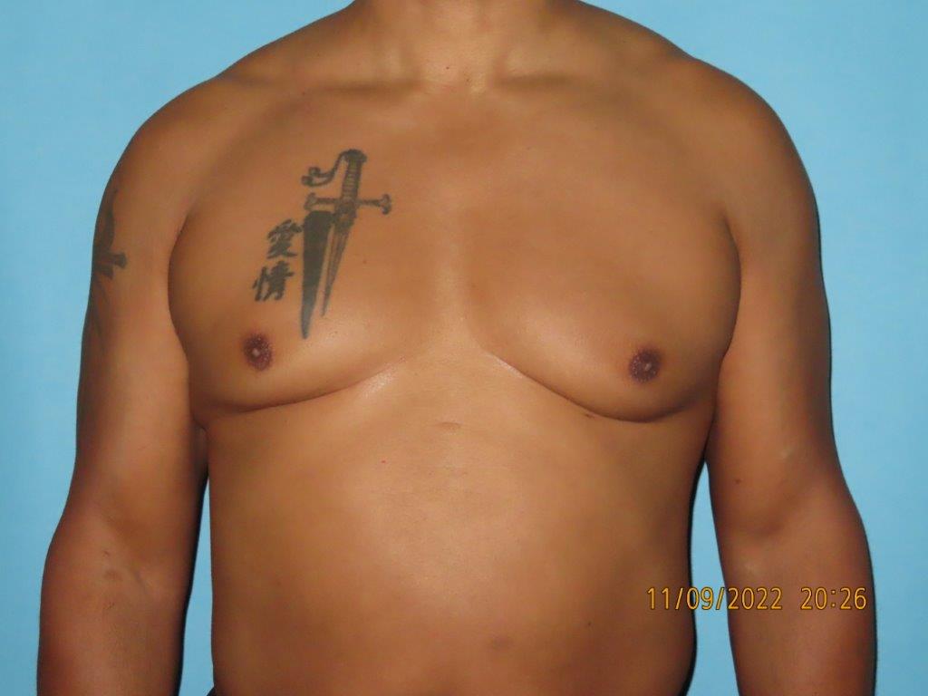 Male Breast Reduction - Gynecomastia