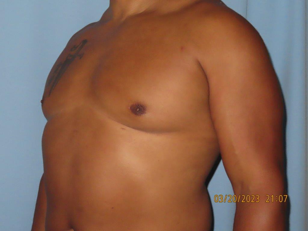 Male Breast Reduction - Gynecomastia