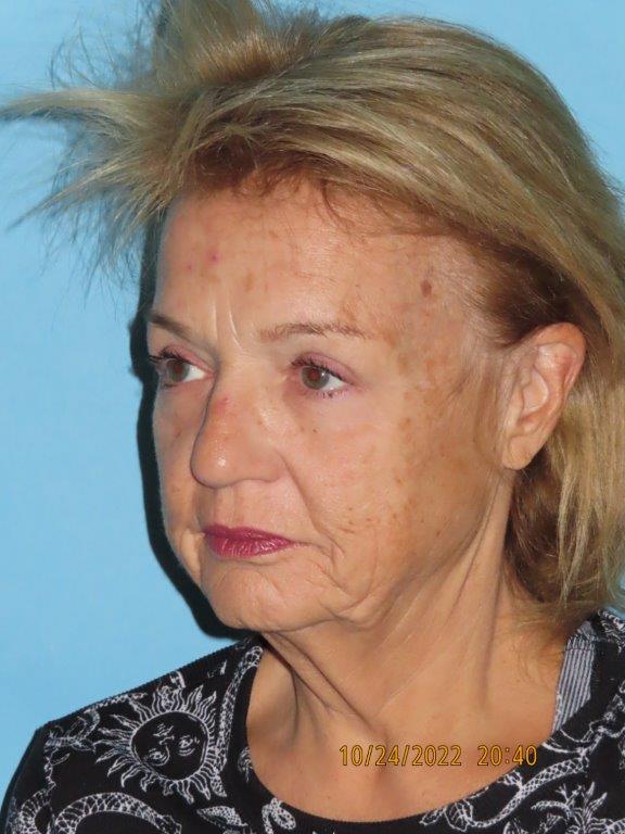 Facelift
