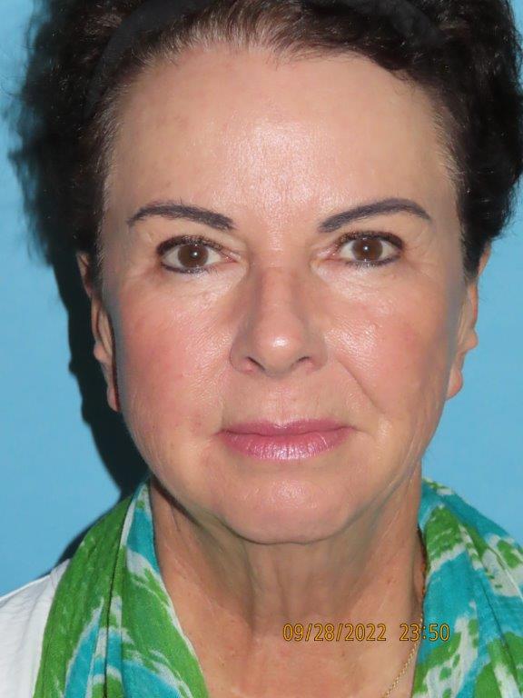 Facelift