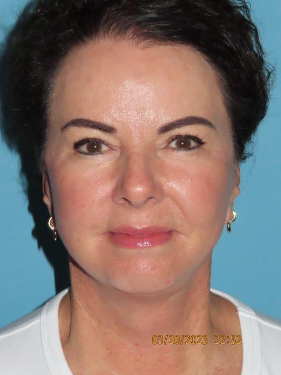 Facelift