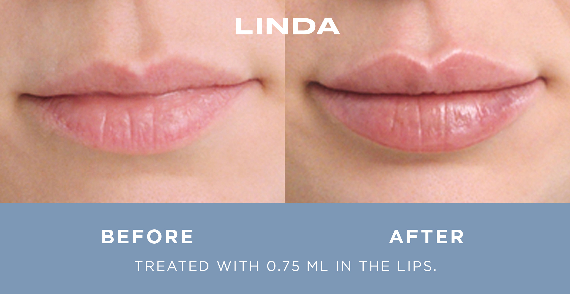 Before and After Image of Dermal Facial Fillers Phoenix
