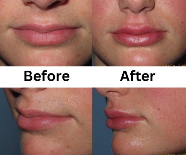 Lip filler