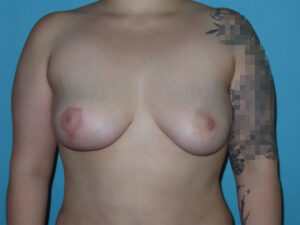 Breast Procedures