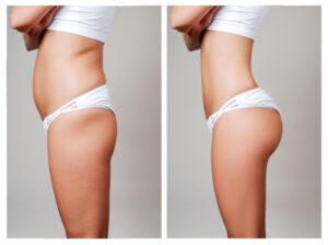 Contouring Your Body With Liposuction