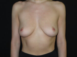 Breast Augmentation