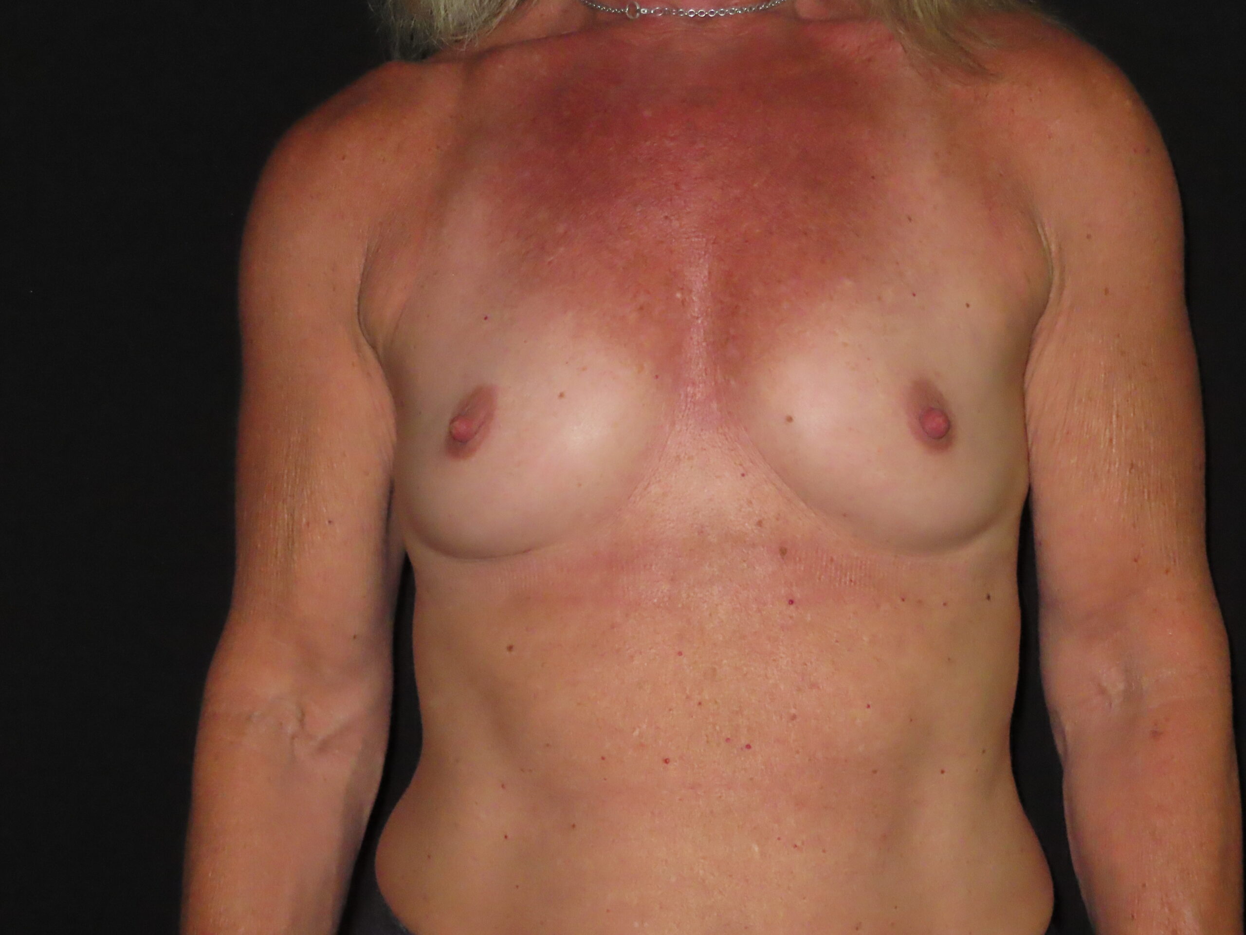Breast Augmentation
