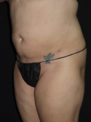 Body Procedures