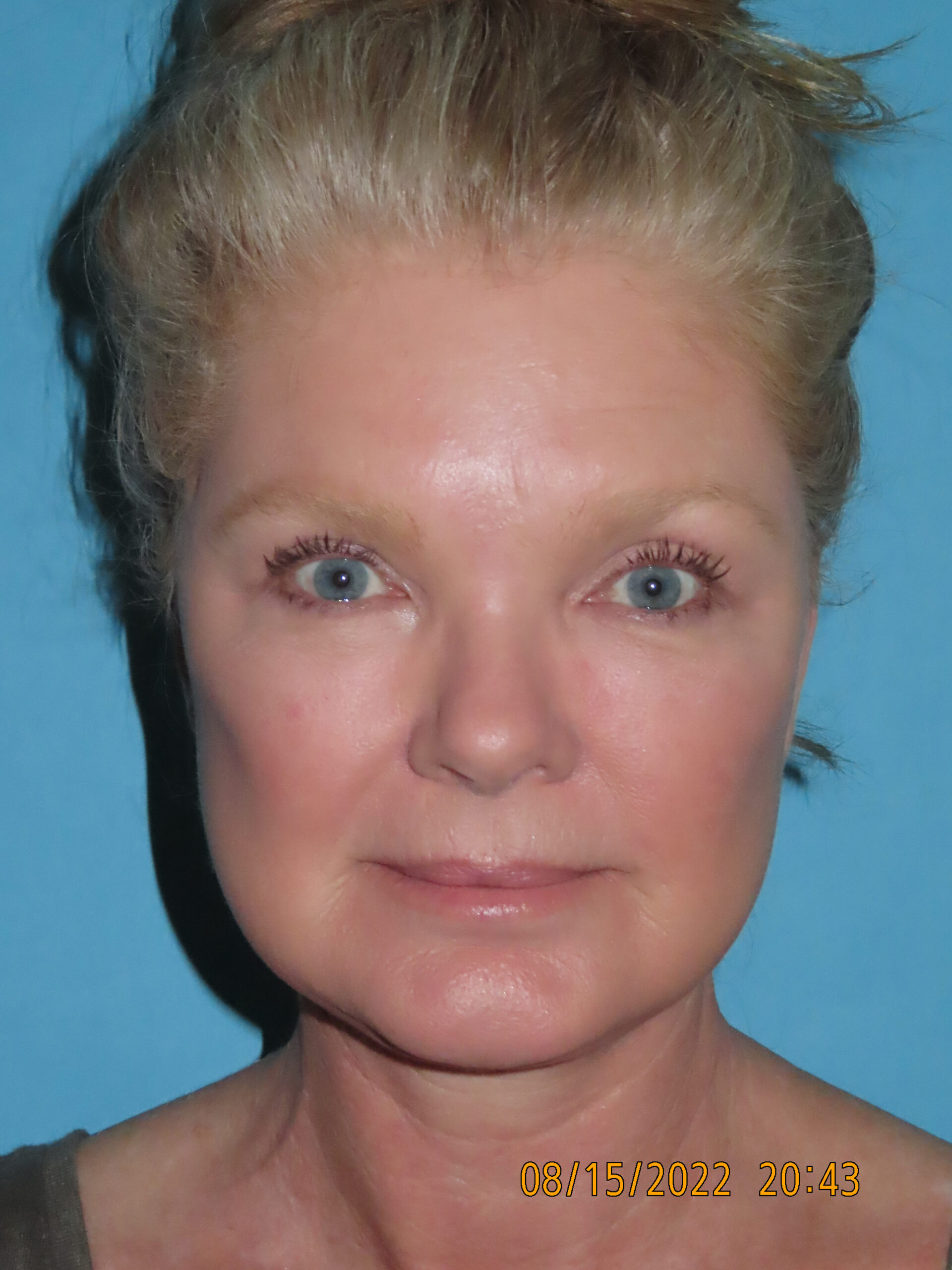 Facelift