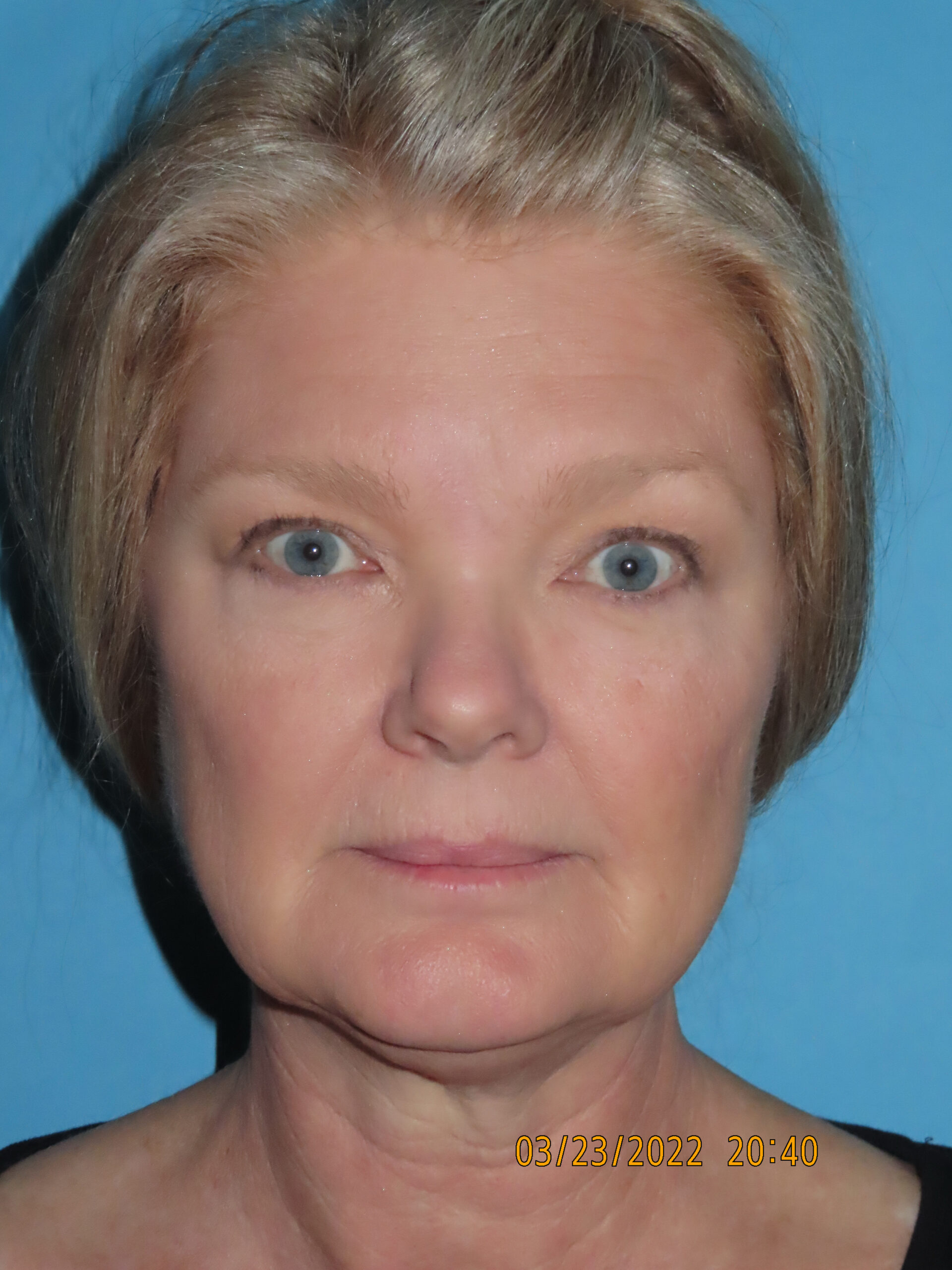 Facelift