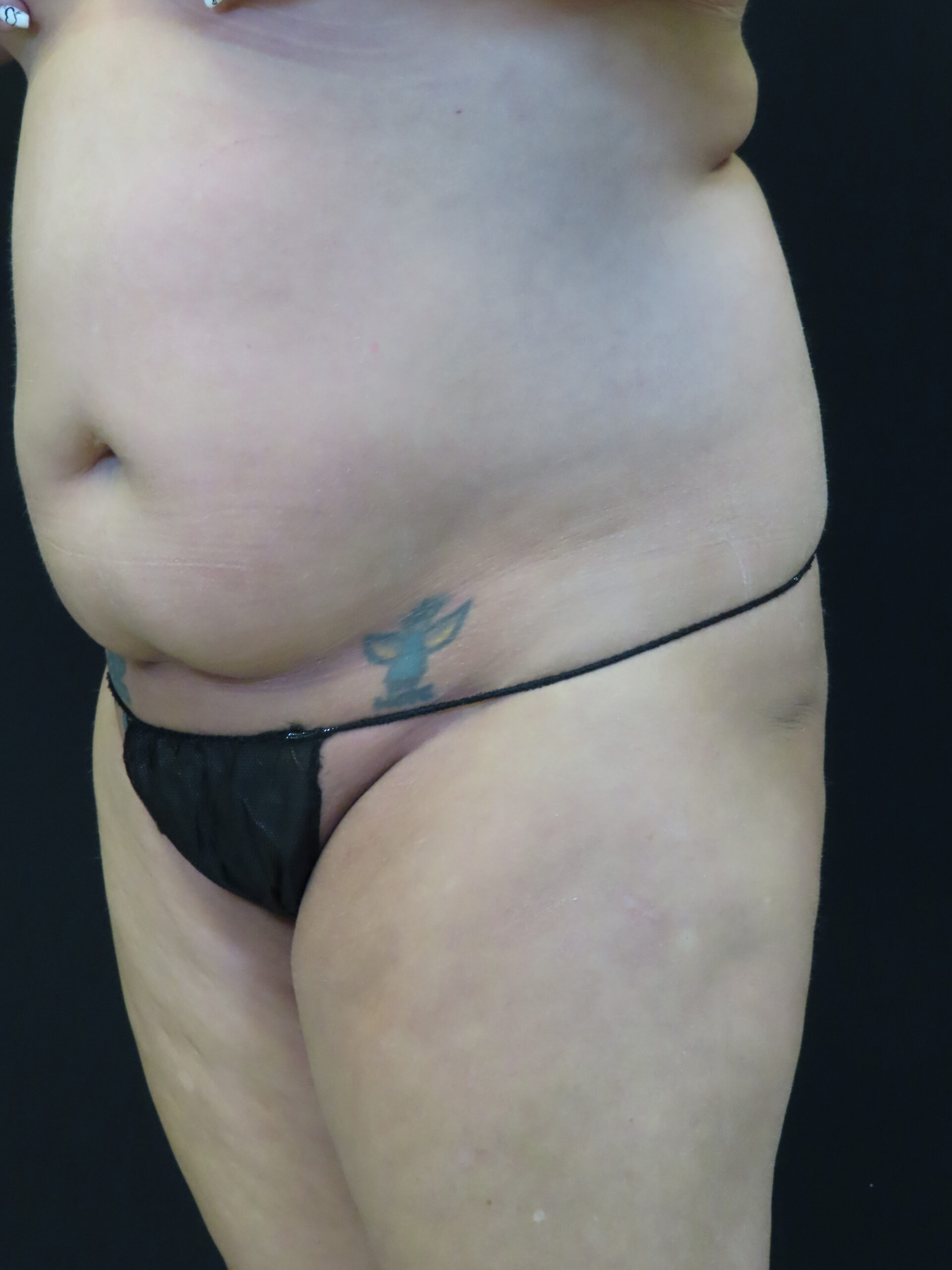 Body Procedures