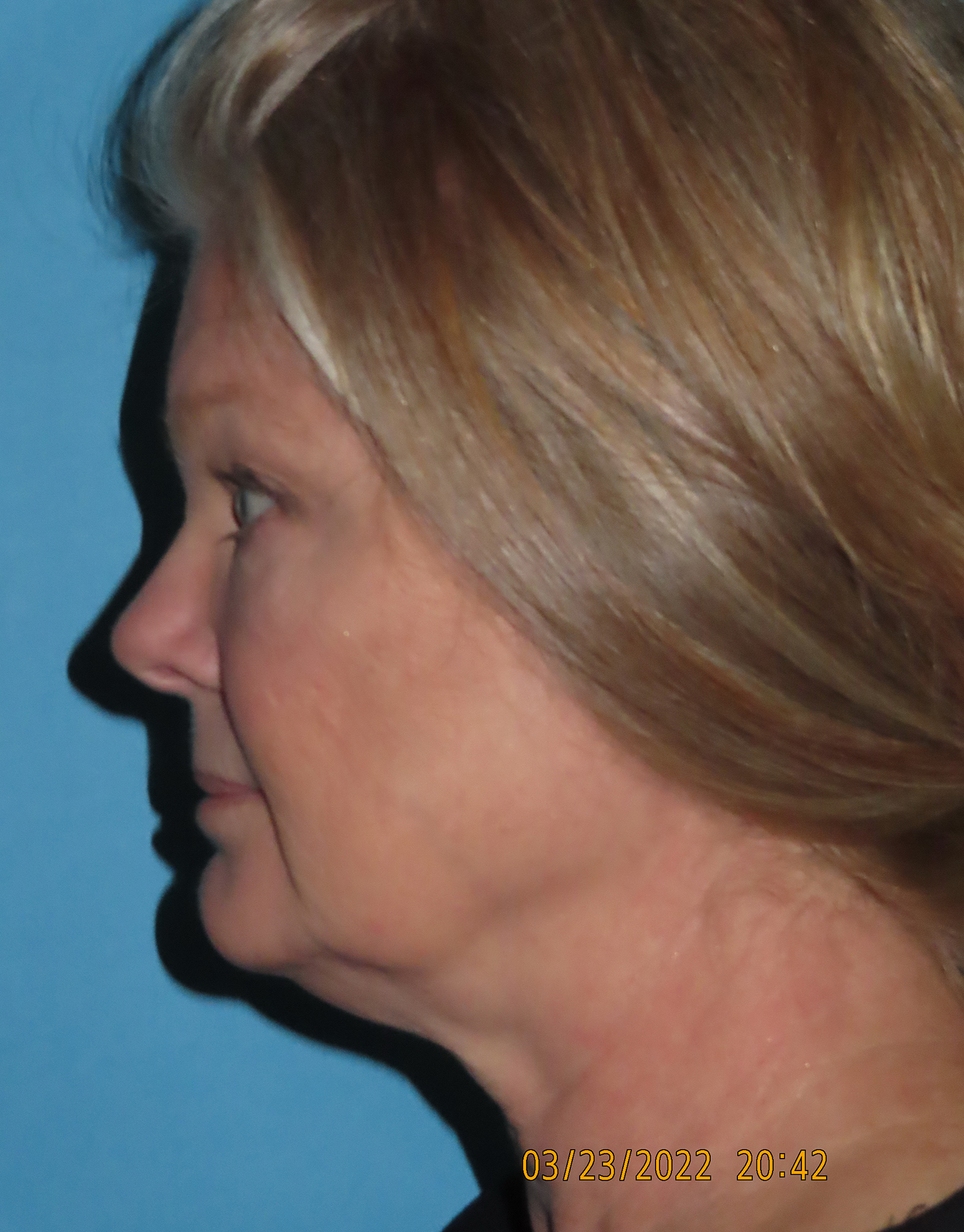 Facelift