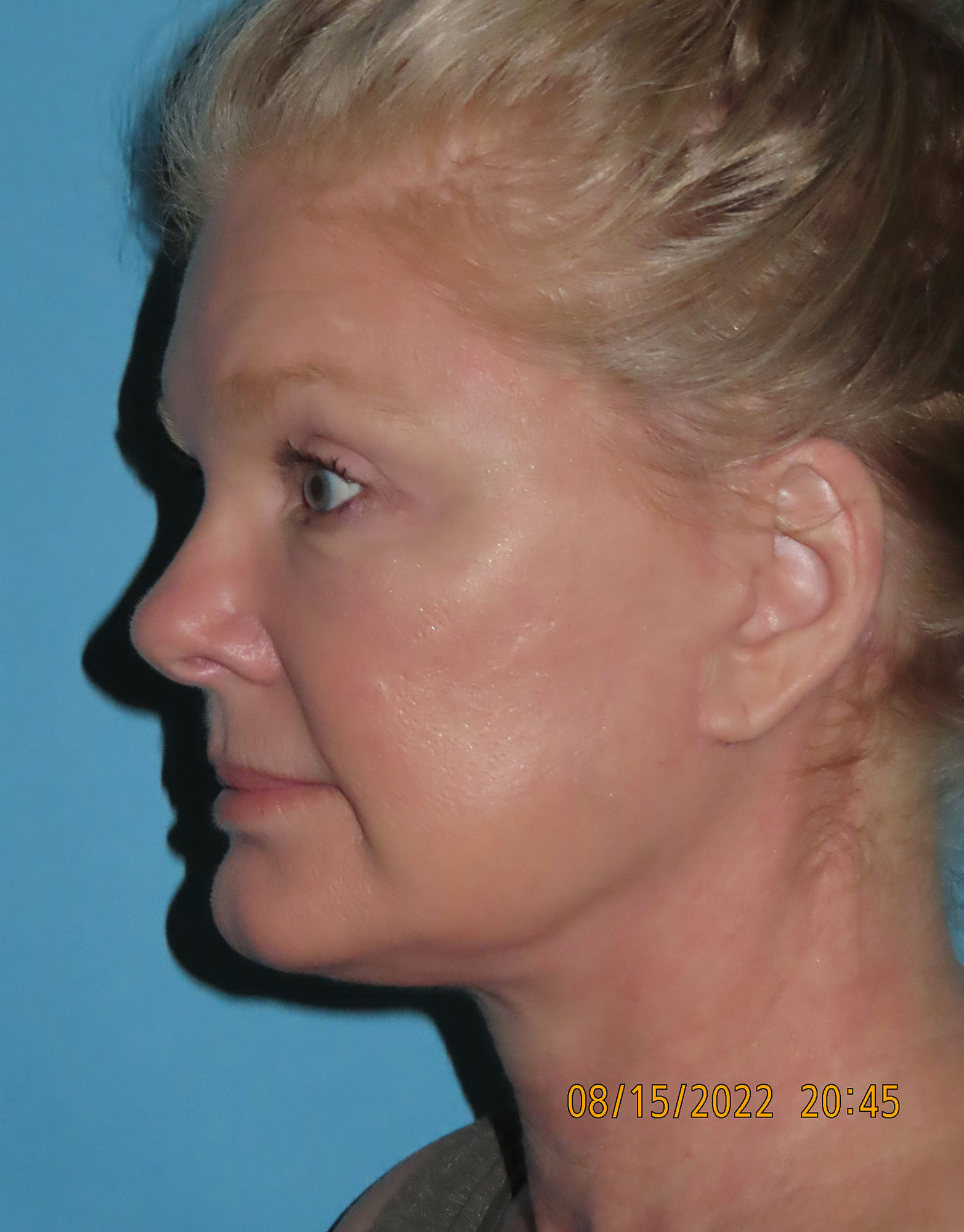 Facelift