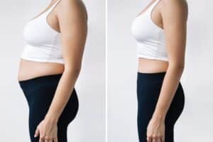 Before and after images of a woman who has received liposuction at the practice of Dr. Sean T. Lille, MD, PC