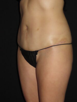 Body Procedures