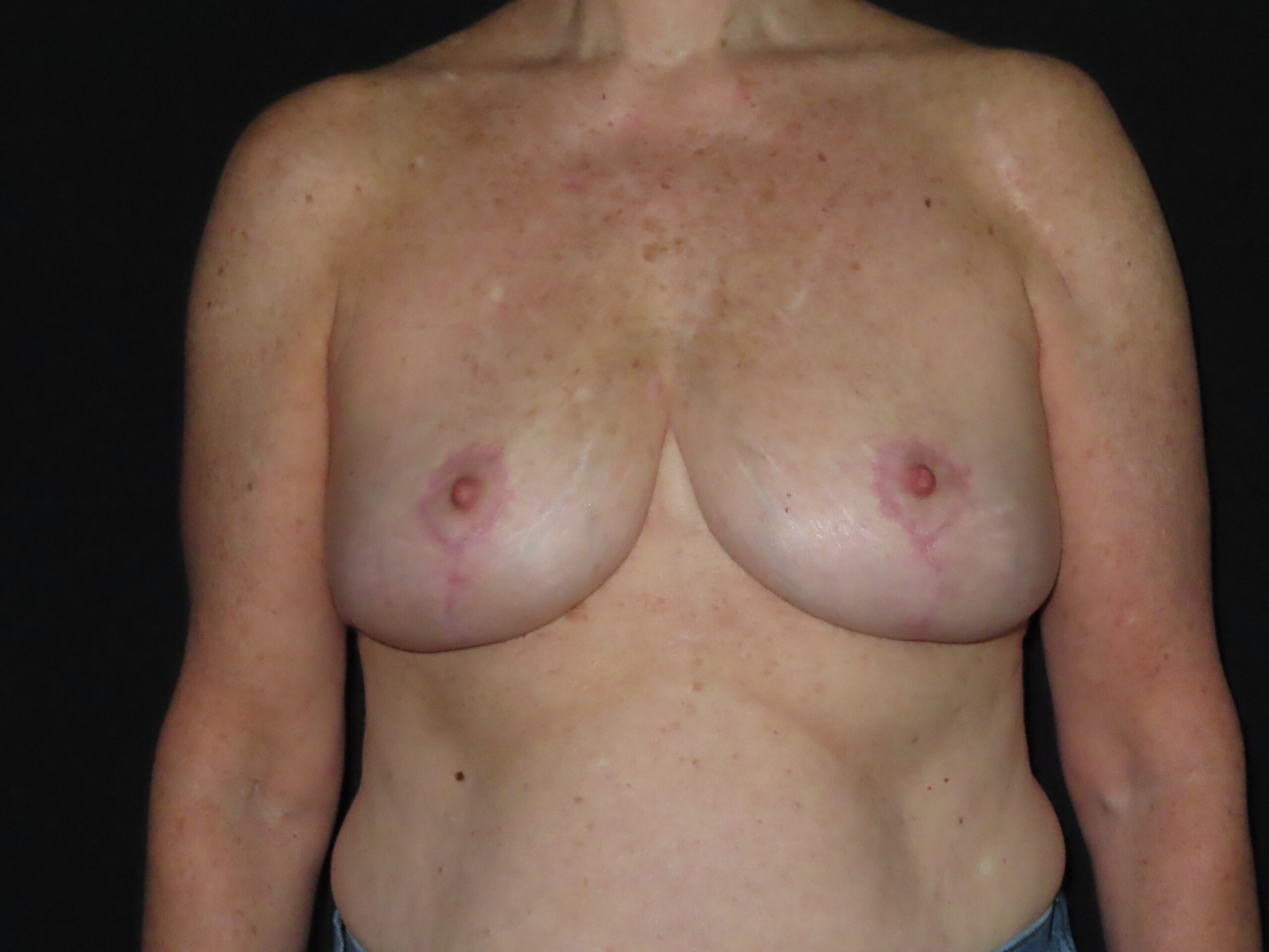 Breast Implant Removal with Breast Lift
