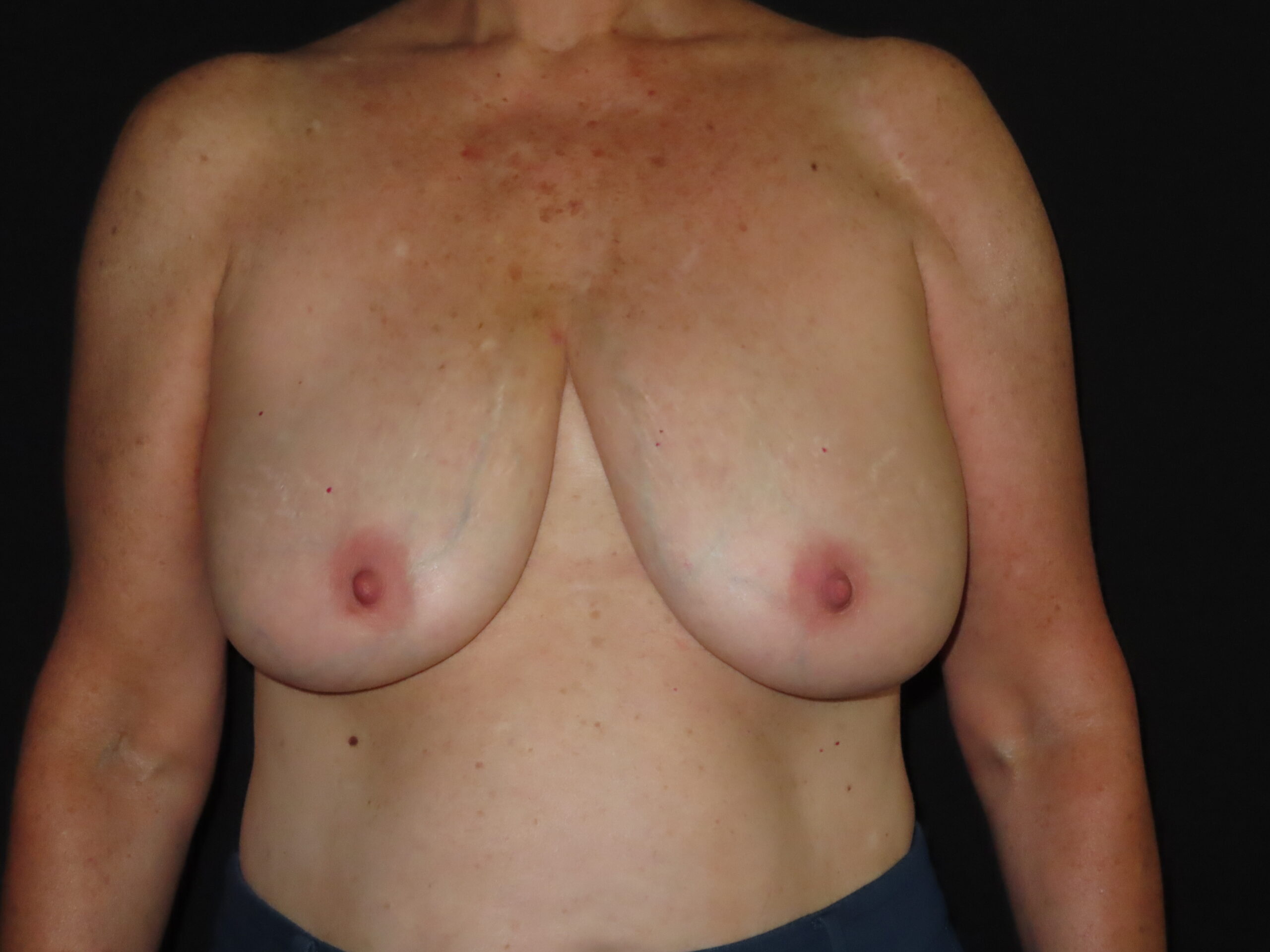 Breast Implant Removal with Breast Lift