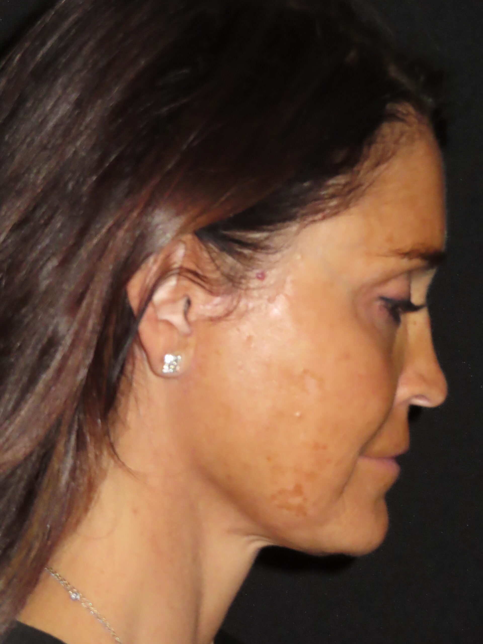 Facelift